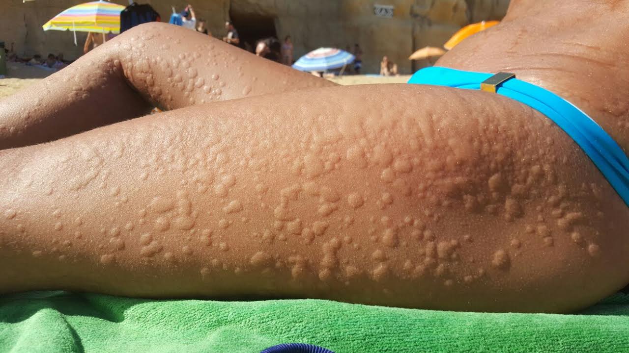 Urticaria a frigore